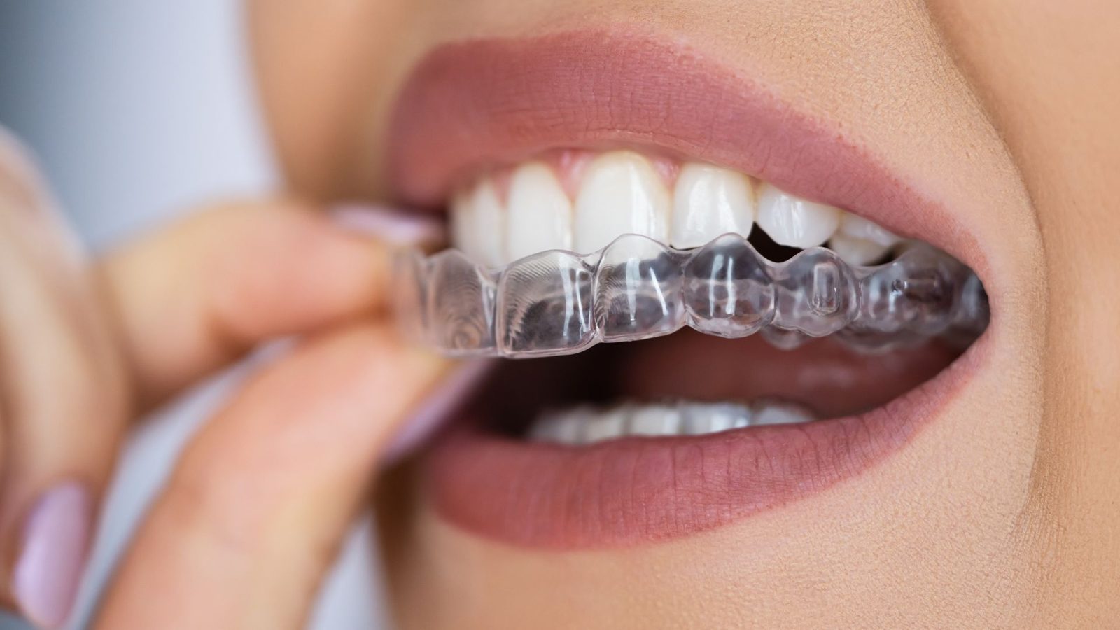 Aligneur transparent mis en place sur les dents