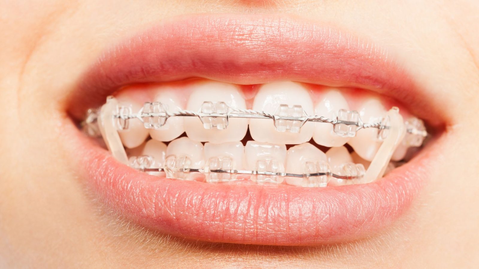 Sourire avec un appareil orthodontique à bagues céramique