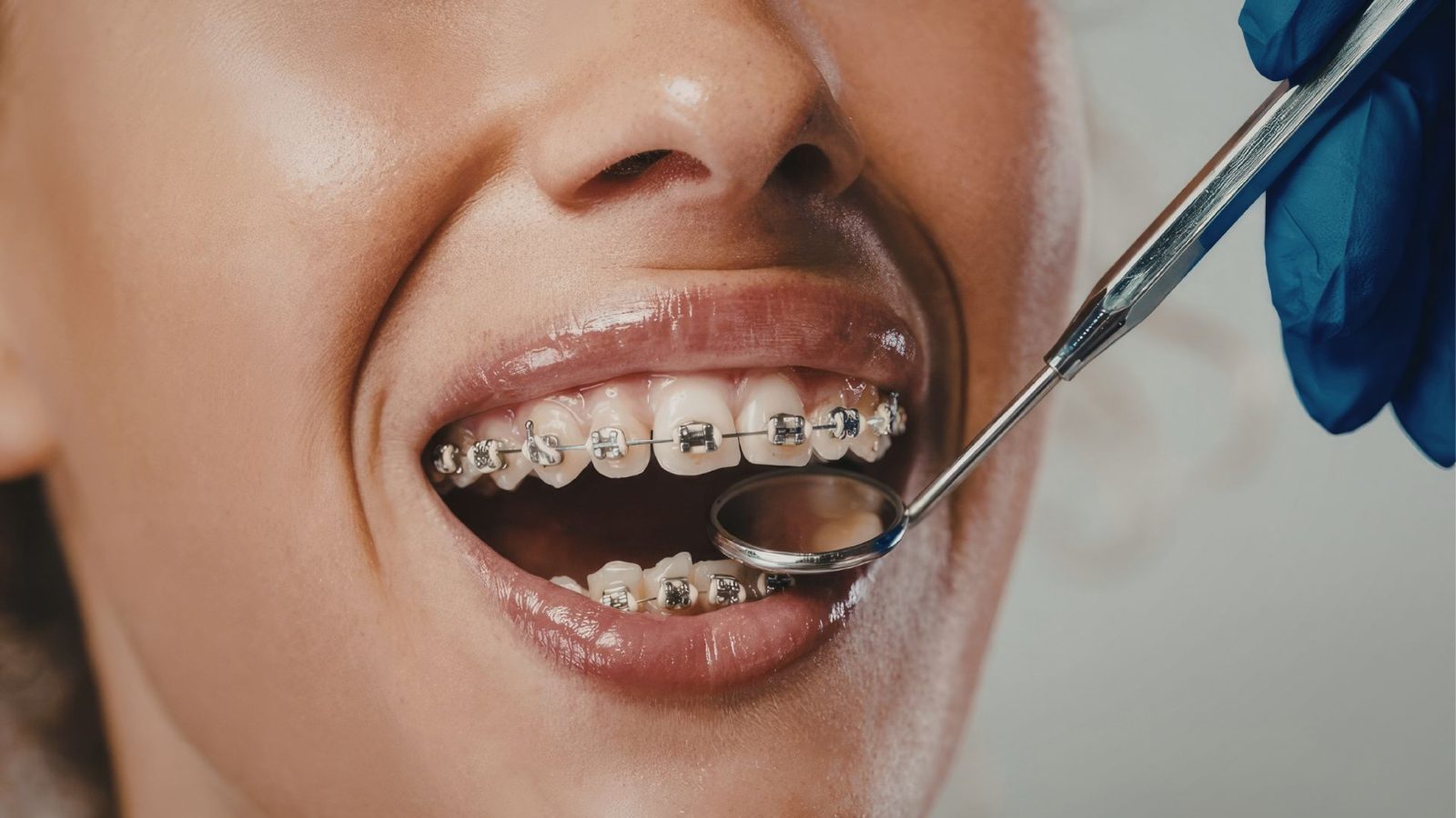 Contrôle au miroir d’un appareil orthodontique à bagues métalliques
