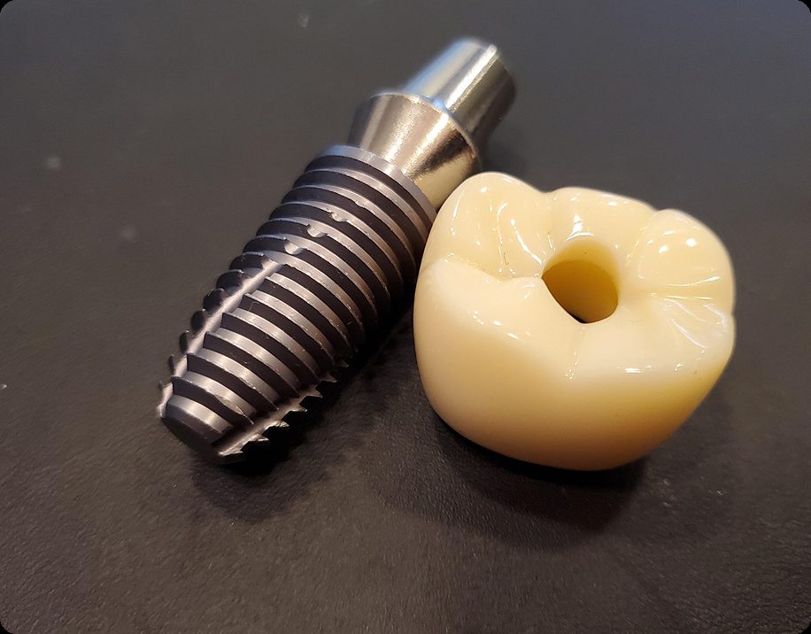 Implant dentaire en titane posé à côté de sa couronne