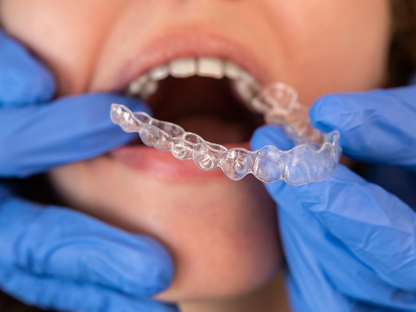 Gouttière d’alignement transparente mise en place par des mains gantées