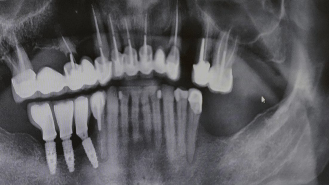 Radiographie panoramique montrant les dents, leurs racines et l’os qui les porte
